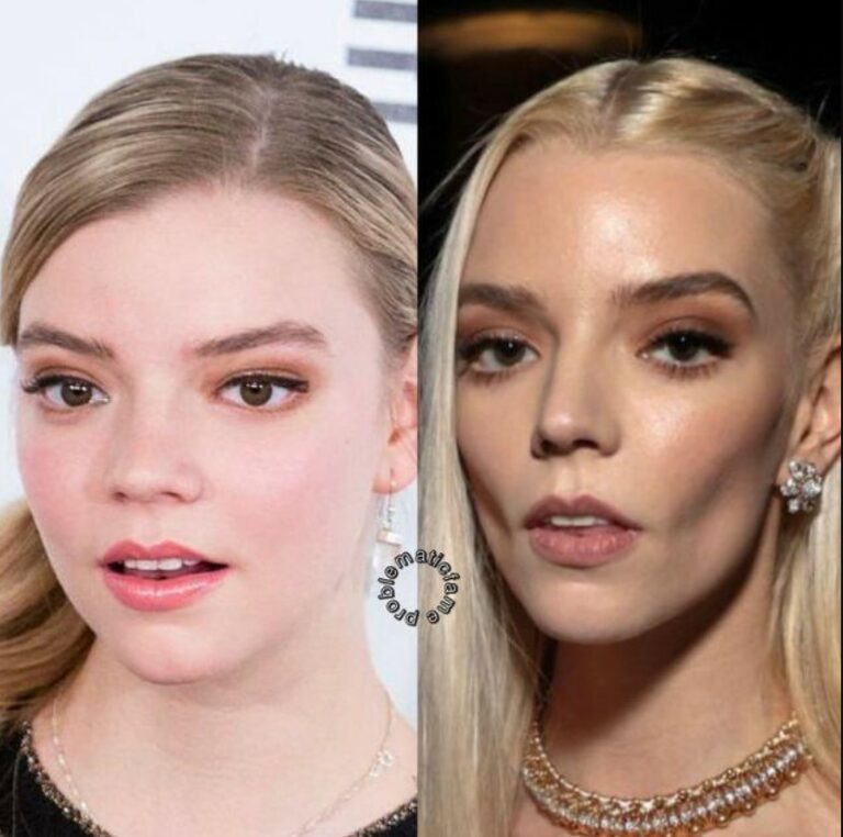 Anya Taylor-Joy: Exploring the Transformation Amidst Speculations